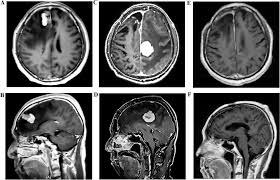 Image result for Brain Lesion