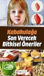 Kabakulak Nedir Nasil Bulasir Kabakulak Hastaligina Ne Iyi Gelir Anne Cocuk Dogal Tedaviler Saglik Dogal
