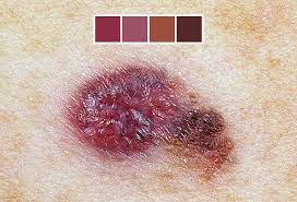 skin cancer photos what skin cancer precancerous lesions