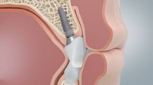 Implant Dentar Intrebari Si Raspunsuri Preturi Implanturi Mdlpl