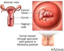 The menopause may be naturally premature or early. Cervical Cancer Multimedia Encyclopedia Health Information St Luke S Hospital