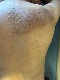 Image result for Notalgia Paresthetica