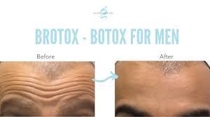 Check spelling or type a new query. Brotox Botox For Men Glen Dental