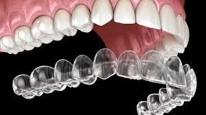 Most people start noticing some movement, however, within the first two months after getting their first set of aligner trays. Invisalign Prices Los Angeles How Much To Pay For Invisalign In California