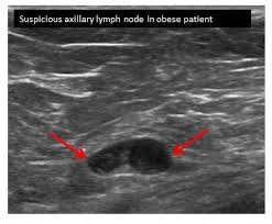 A new study adds to the evidence that ultrasonography can help diagnose cancer in women with dense breasts. Lymph Node Ultrasounds More Accurate In Obese Breast Cancer Patients