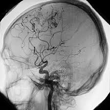 Protocolo para el diagnóstico y certificación de la muerte encefálica. Done Vida California How Organ Donation Works What Is Brain Death