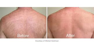 Hairless nyc electrolysis clinic is located on the upper east side and has been offering electrolysis electrolysis is the only permanent hair removal method to treat unwanted hairs due to hirsutism. Best Laser Hair Removal Nyc Dermatology And Laser Group