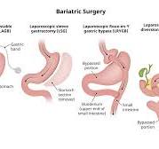 Bariatric Weight Loss Surgery | Gleneagles Hospital