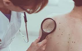 Maria trimarchi moles can appear at any time during your life. Are Atypical Moles A Sign Of Melanoma U S Dermatology Partners Blog