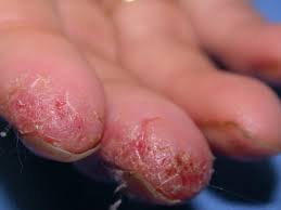 I tried several creams and lotions, and. Hand Eczema