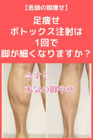 足痩せボトックス注射は 1回で脚が細くなりますか ふくらはぎ ダイエットのモチベーション 痩せ