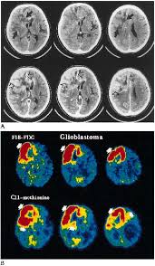 Unenhanced Ct Scan Meaning Ct Scan Machine