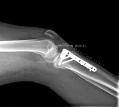 Ouch Knee X Ray Broken People X Ray 2021x1832 Download Hd Wallpaper Wallpapertip