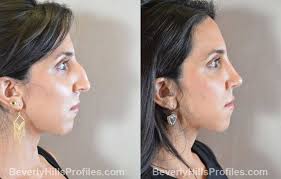 Thanks to my genes, i'll never know the pleasure of drinking from a champagne glass without tipping my entire head back or kissing straight on without bumping noses. Rhinoplasty Before After Photos At Beverly Hills Profiles