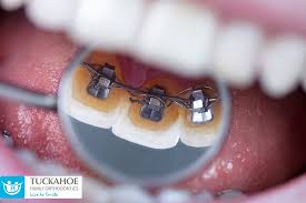 Inner braced furniture has had meagre advertising publicity, except through its sales. Lingual Braces What Are They And What Should You Know
