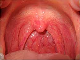 Drainage from a sinus infection can cause a sore throat. Sore Throat Wikipedia