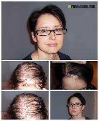 ➨ jetzt über günstige optionen informieren! Haartransplantation Forum Frauen Shefalitayal