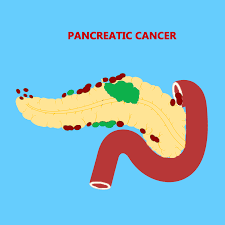 The following are the typical signs and symptoms Best Cancer Hospital In India Pancreatic Cancer Treatment In Coimbatore Tamil Nadu