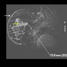 Additional imaging tests, such as an mri, may be recommended in certain situations. Inflammatory Breast Cancer Eurorad