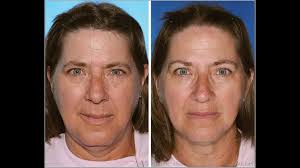 What happens to your skin when you tan in the sun? Twins Study Shows Smoking Ages Your Face Faster Cnn