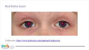 Image result for Red Reflex