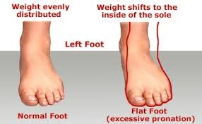 Last week during a 6mile run i felt discomfort on my foot but ran a last mile on it mostly running it on my toes since landing the heel made it hurt. What Is Flatfoot And Why Should We Worry About It Great Basin Orthopaedics