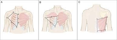 Klicken sie hier um mehr informationen zu dieser webseite zu erhalten. Chest Wall Reconstruction In Male Poland Syndrome Patients With Endoscopic Assisted Latissimus Dorsi Muscle Flap Transfer Journal Of Plastic Reconstructive Aesthetic Surgery