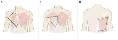 604 x 453 jpeg 42 кб. Chest Wall Reconstruction In Male Poland Syndrome Patients With Endoscopic Assisted Latissimus Dorsi Muscle Flap Transfer Journal Of Plastic Reconstructive Aesthetic Surgery