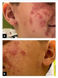 Itp is a fairly common blood disorder that both children and adults can develop. Cureus Problematic Purpura
