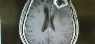 May bladder cancer is the fourth most common cancer in men. Biocept Inc Launches Its Cnside Cerebrospinal Fluid Assay For Early Detection Of Metastatic Brain Cancer