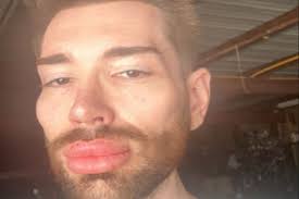 'Żywy Ken' pokazał się po operacji powiek i usunięciu wypełniaczy. 'Wygląda  o wiele lepiej'