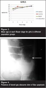 Image result for Risser Sign