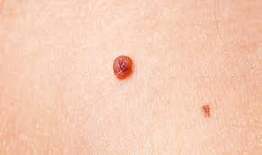 The skin cancer foundation estimates doctors diagnosed ov. Skin Cancer Symptoms Tumour Cases Rise Signs To Look Out For And How To Prevent It Express Co Uk