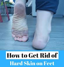 How does it look like? How To Get Rid Of Dead Skin On Feet Step By Step Guide Dead Skin On Feet Dry Skin On Feet Hard Skin On Feet