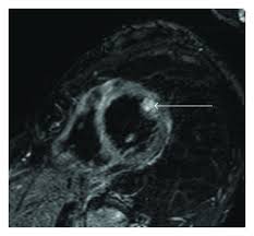 Cardiac magnetic resonance (mr) is currently the preferred imaging modality for the diagnosis of myocarditis. Figure 4 T2 Weighted Cardiac Magnetic Resonance Imaging Of Edema In Myocardial Diseases