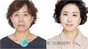 By far the most common surgery that koreans do, according to dr. Korean Tl Plastic Surgery Everyone Has The Right To Look Beautiful Useful Advice By Tl Plastic Surgery For Your Smooth Skin And Skin Elasticity Business Wire