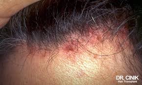 Image result for white scabs on the head in children