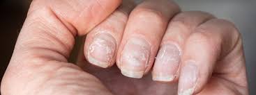 Image result for Akutní zánět nehtového lůžka