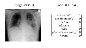 Image result for Chest XRay Interpretation