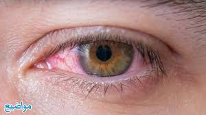 الحلم بان الميت يشتكى عدم الرؤية. ØªÙØ³ÙŠØ± Ø±Ø¤ÙŠØ© Ù…ÙŠØª ÙŠØ´ØªÙƒÙŠ Ù…Ù† Ø¹ÙŠÙ†Ù‡ ÙÙŠ Ø§Ù„Ù…Ù†Ø§Ù…