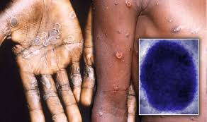 Monkeypox results from infection by the monkeypox virus, an orthopoxvirus related to the variola (smallpox), vaccinia, cowpox, buffalopox, and camelpox . Monkeypox Virus Infection Spread In Uk By Clothes And Sneezing Express Co Uk