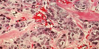 As the tumor grows, cancer cells can break away from the. New Evidence Suggests Early Metastasis Is Common In Lung And Breast Cancers Scope