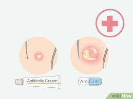 Use a sharp razor and always shave in the direction of hair growth. How To Get Rid Of Ingrown Pubic Hair With Pictures Wikihow