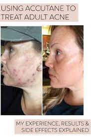 Accutane approximately 1 hour before sexual activity. Accutane For Adult Acne My Experience