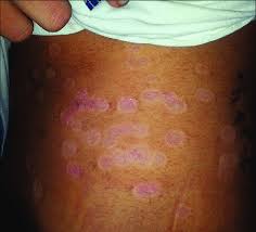 Image result for Postinflammatory Hypopigmentation