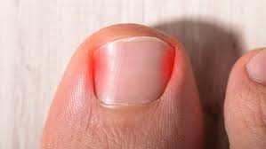 Oct 30, 2017 · depending on which toenail fell off, it can take anywhere from six months to two years for the nail to completely grow back. Ingrown Toenail Treatment Weil Foot Ankle Institute