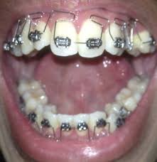 Warna karet behel yang lucu, warna karet behel yang cantik di gigi, warna behel gigi yang cantik, warna behel yang lagi trend, warna karet behel trend 2020, warna behel yang bagus untuk laki laki, warna karet behel yang lagi trend 2020, warna karet behel untuk pria, Pengalaman Pasang Behel Kawat Gigi Di Rsgm Prof Soedomo Fkg Ugm Monyoku