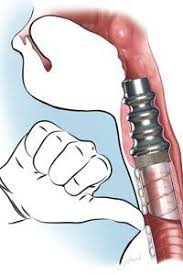 Ventes de disques, de singles, de produits d�riv�s ou nombre de fans. Le Premier Larynx Artificiel Du Monde Est Francais