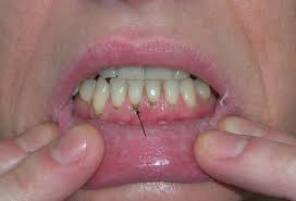 Image result for Lead Poisoning