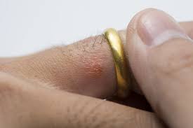 Nickel allergy signs and symptoms include: Can T Wear Your Wedding Ring You Could Have A Metal Allergy Get Ordained